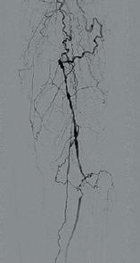负压封闭引流治疗糖尿病足的原理,糖尿病足血管闭塞怎样治疗好