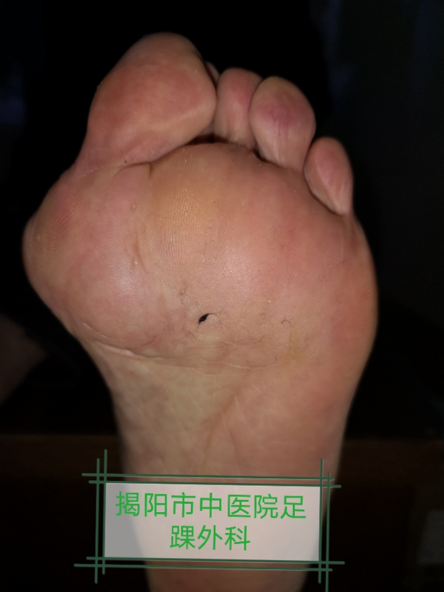 关注足部的健康,关注足部健康