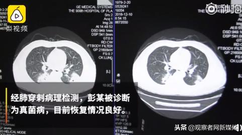 臭袜子真菌感染,一双臭袜子引发的惨剧