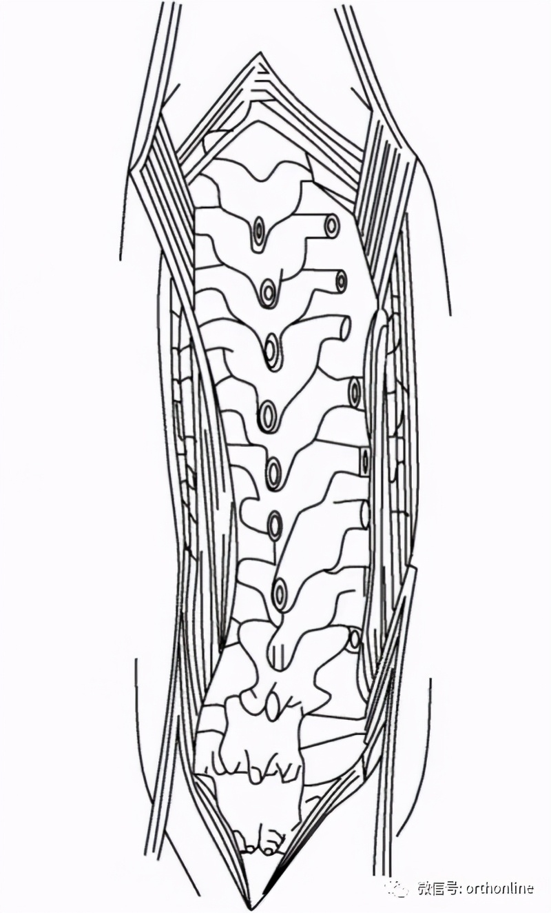 植骨手术的成功攻略,什么情况需要植骨手术全过程