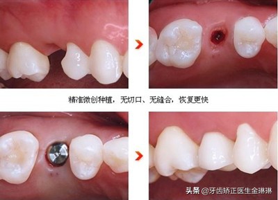 后牙做烤瓷牙冠还是全瓷牙冠,后槽牙做全瓷牙冠会不会掉