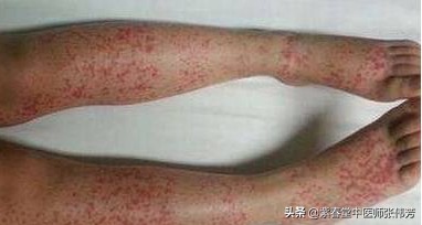 过敏性紫癜留下的色素沉着怎么治,过敏性紫癜出血点都在什么位置