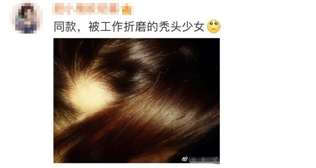 美女主持人突然上热搜，网友纷纷晒同款！脱发原来是毛囊“休息”了