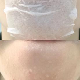 脸上长闭口怎么办教你正确去闭口,去闭口最简单的消除方法