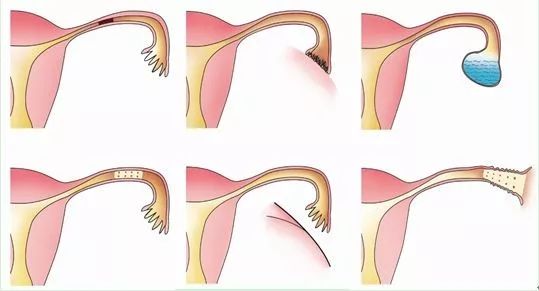 没做过人流,为何也成为输卵管堵塞的受害者?