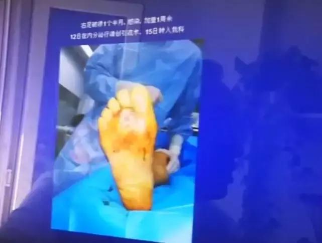 脚底起老茧是糖尿病引起的吗,糖尿病脚底老茧怎么治愈