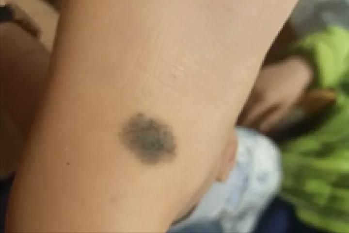 一般凸起的黑痣会癌变吗,长了20多年的黑痣有可能会癌变吗