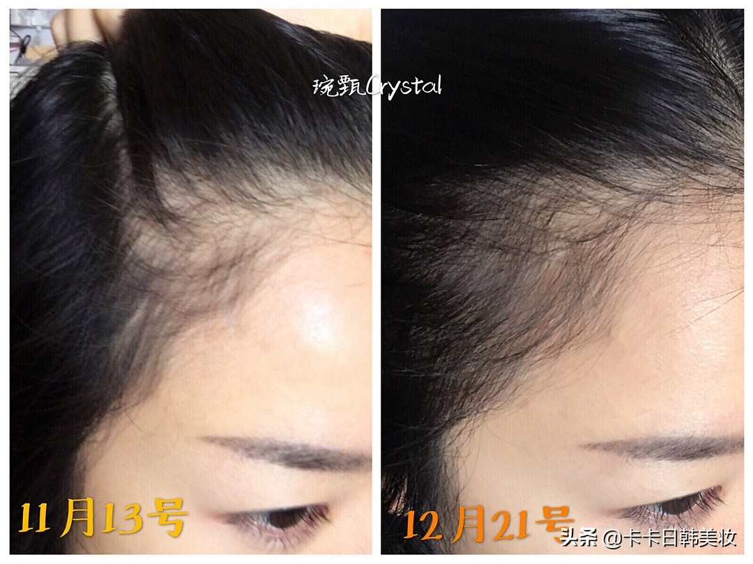 经常掉头发有什么好的洗发水,柳屋生发液真实测评还能用吗