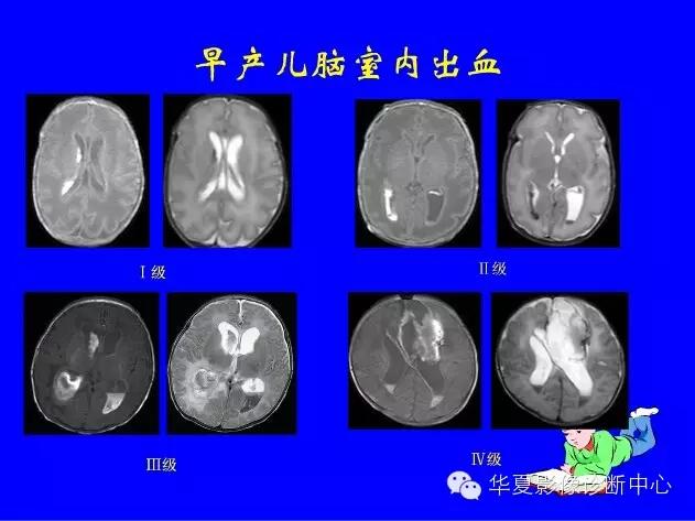 新生儿颅脑mri,新生儿颅脑mr报告模板