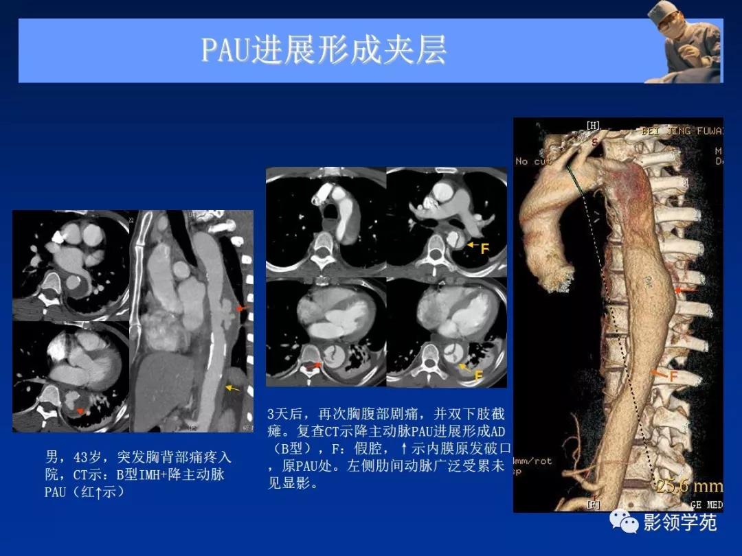 主动脉夹层壁间血肿如何鉴别,主动脉夹层血肿溃疡