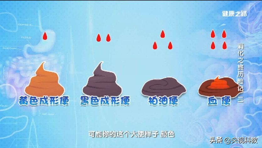 幽门螺旋杆菌胃出血怎么治疗,胃出血幽门螺杆菌患者可以吃什么