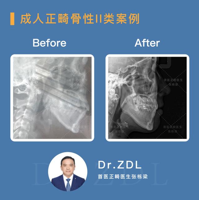 骨性龅牙做正畸还是正颌,骨性龅牙正颌手术前要正畸吗