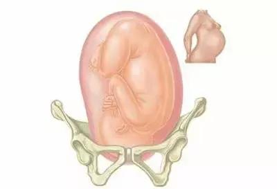 胎儿不入盆正常吗,胎儿像肿瘤一样