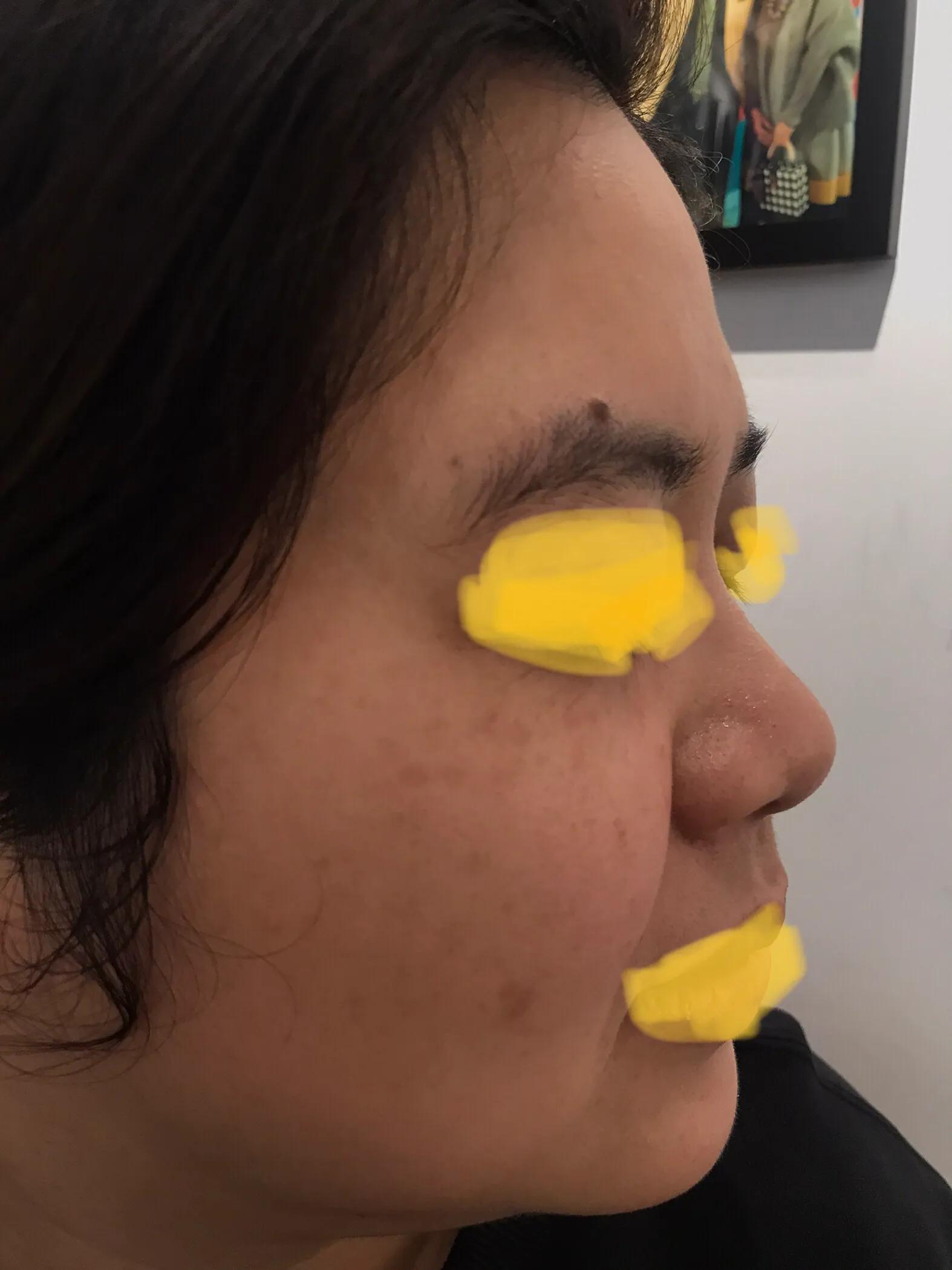 激光祛斑后斑片更大更黑了怎么办,两次祛斑还是反黑