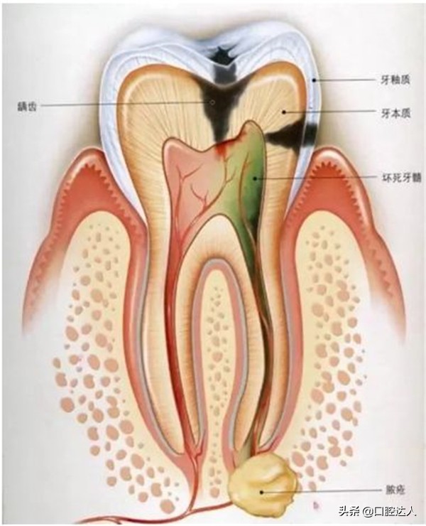 不补牙齿有问题吗,不补牙齿后牙齿会怎样