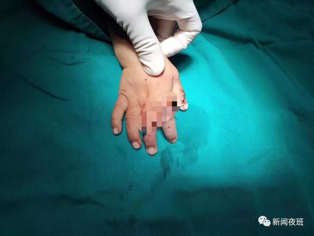 广西一3岁男童在路边玩不慎被石头砸断三根手指