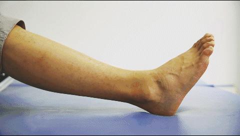 崴脚的预防和治疗,医生分享案例崴脚的科学治疗