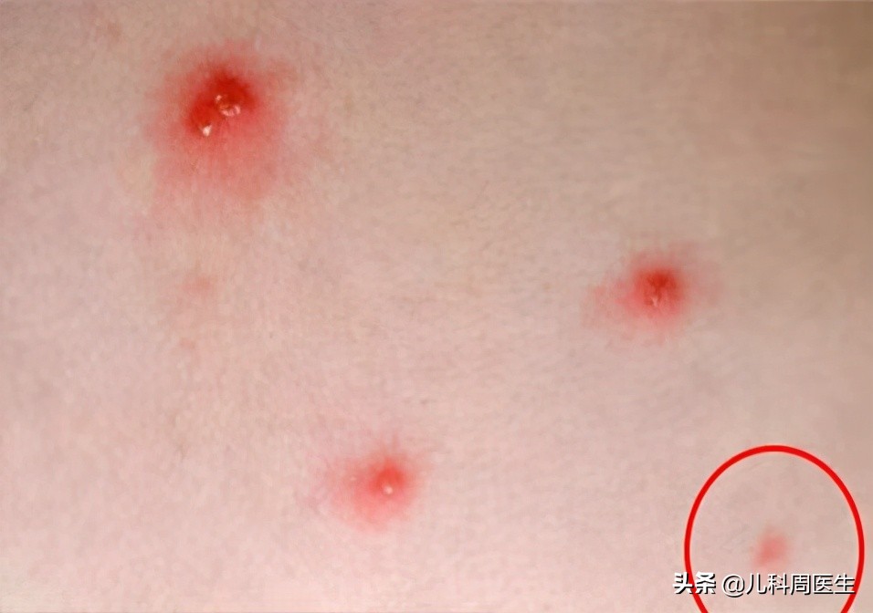 春天起水痘,如何辨别水痘和麻疹