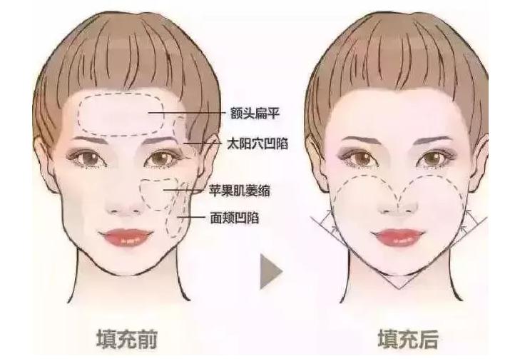 科普|光子嫩肤全攻略,做了光子后禁忌事项有哪些?