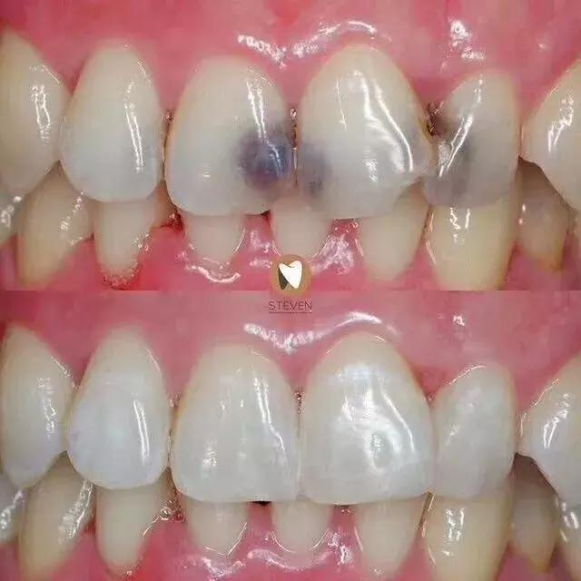 牙齿烂了一半为什么不能补牙,牙齿缺了一半补牙要多少钱