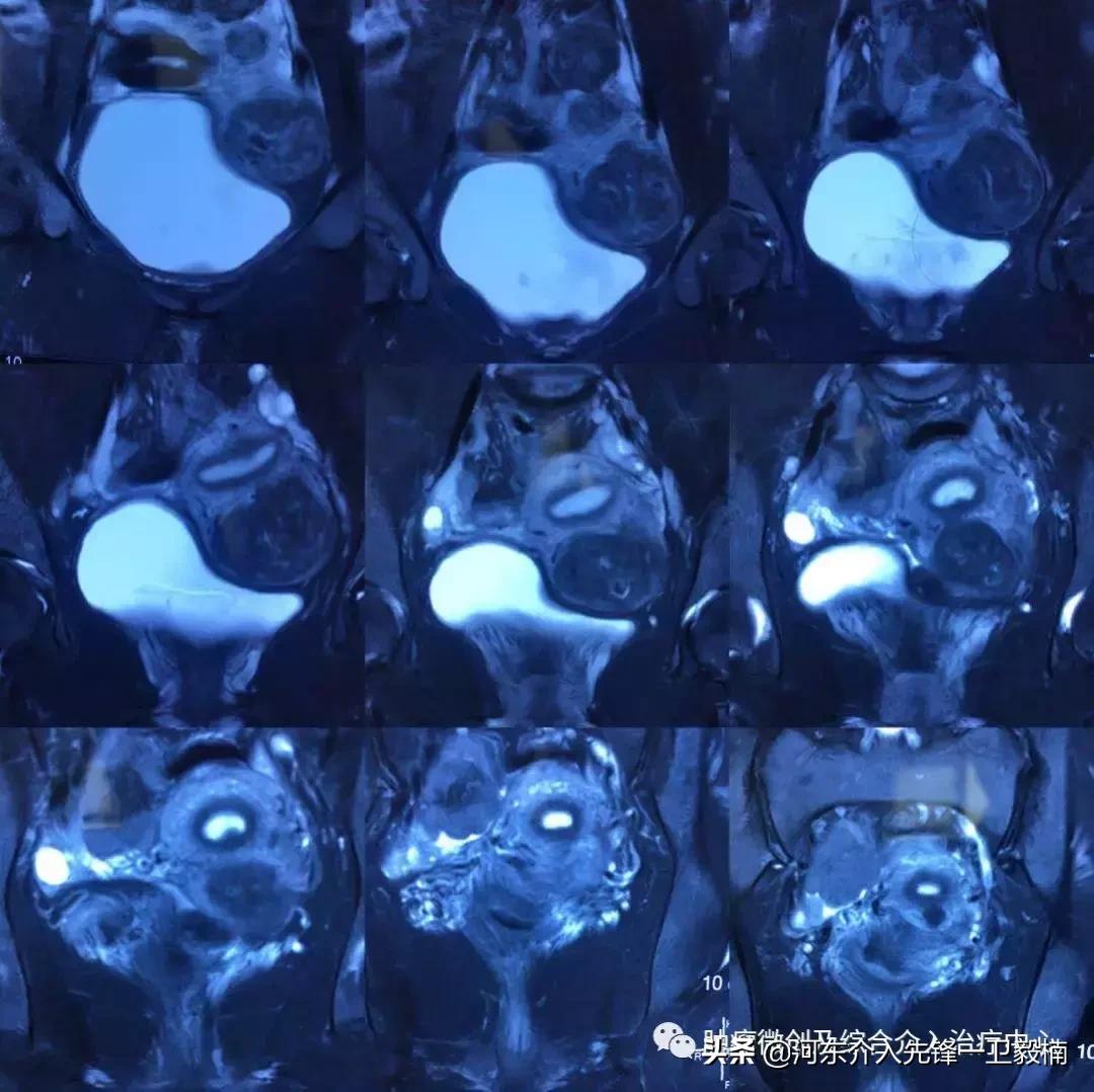 运城市第一医院肿瘤介入科,子宫肌瘤微创手术是超声介入吗
