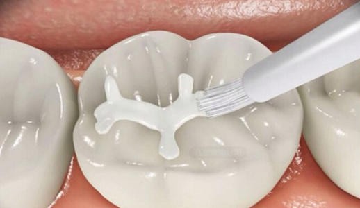 9岁的孩子蛀牙还没有换怎么办,9岁孩子蛀牙需要补牙吗