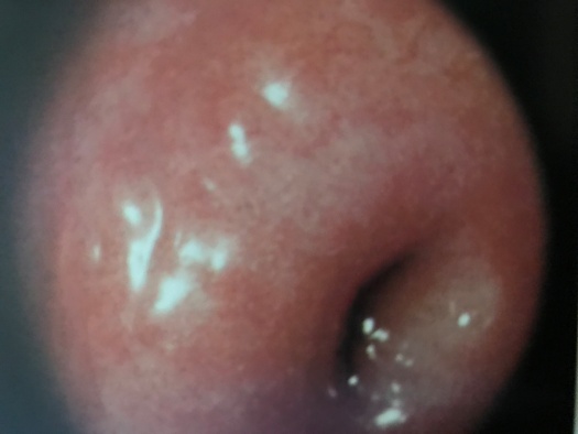 宫颈肥大跟宫颈糜烂是同一种病吗,宫颈糜烂不是病为何还在治