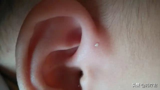 宝宝耳朵旁长小孔妈妈要正确应对,宝宝耳朵上有小孔需要手术吗