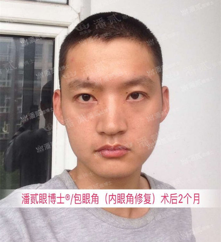 开眼角手术如何避免回缩,开眼角手术常见问题及解决方法