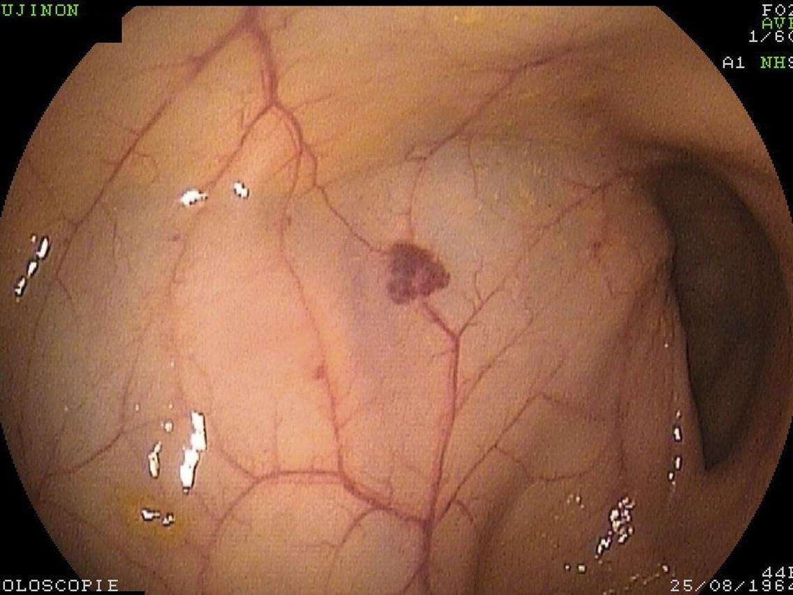 28岁男子排便太用力致脑出血,男人排便出血什么原因