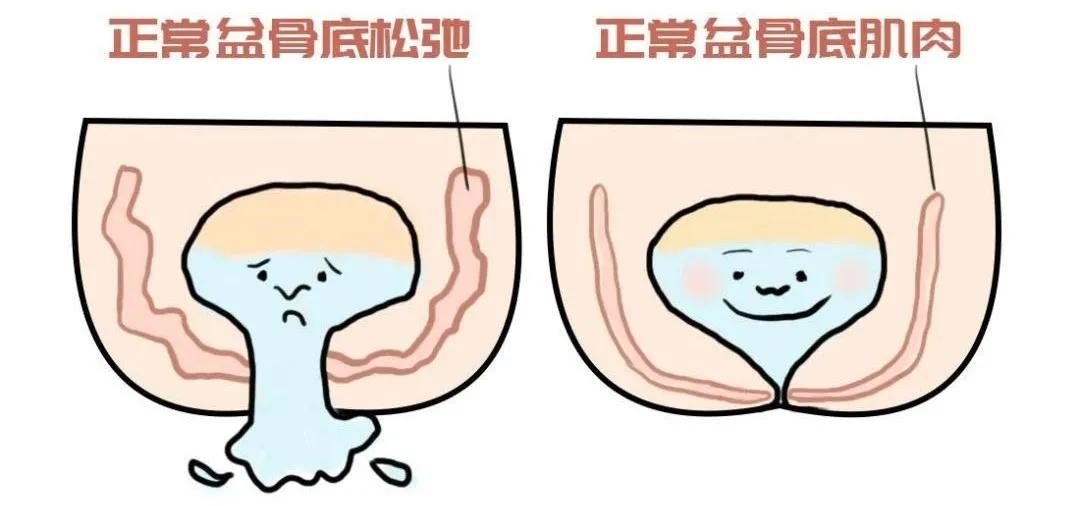 产后4年漏尿修复盆底肌简单动作,产后漏尿修复盆底肌手法简单动作