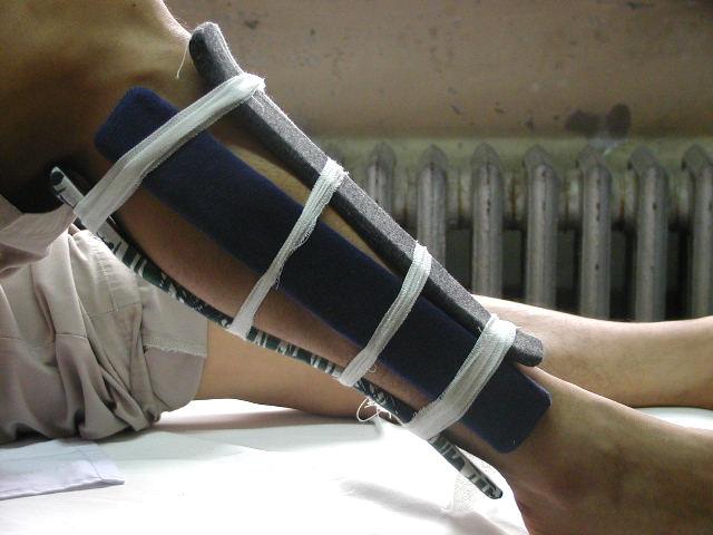 骨折筋伤哪个更容易恢复,骨折后伤筋动骨怎么恢复