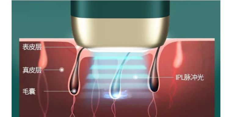 j-style冰点脱毛仪,j-style光子嫩肤脱毛仪