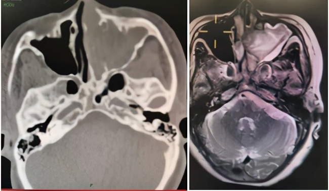 鼻出血象数疗法,鼻出血的常见辨证分型