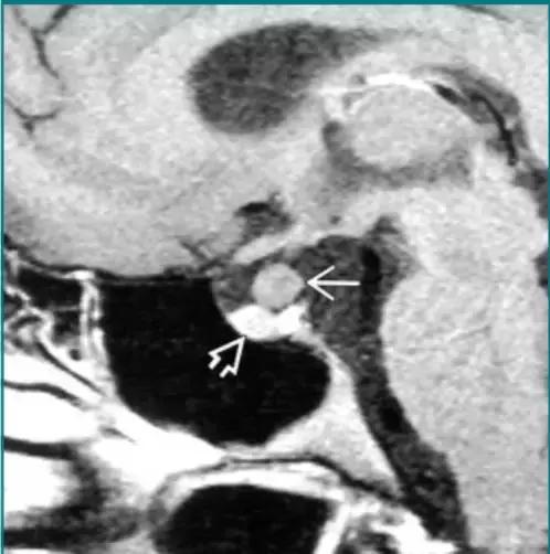 各种囊肿的症状,颅内囊肿18-19mm严重吗