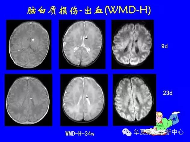 新生儿颅脑mri,新生儿颅脑mr报告模板