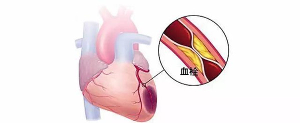心血管狭窄用中药可以治愈吗,中药可以治疗血管狭窄吗