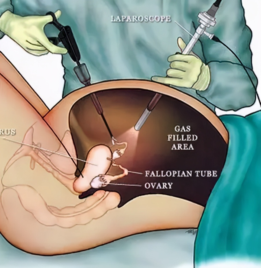 切除子宫后意外发现了宫颈癌,切掉子宫宫颈癌能活30年吗