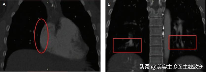 私密整形严重并发症：阴道注射填充剂9小时后永久停止呼吸