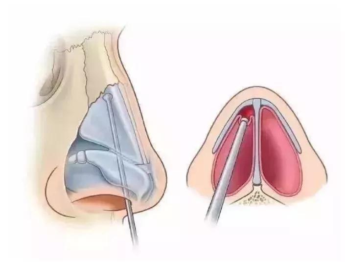 鼻整形增生恢复了鼻子会小吗,鼻整形术后鼻子会肿吗