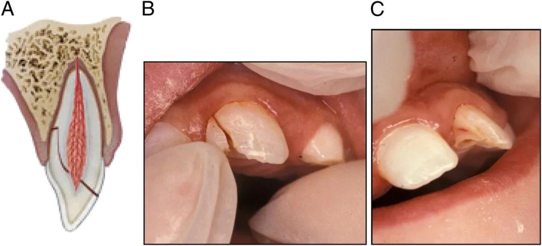宝宝磕掉乳牙还能再长吗,宝宝磕掉牙会长出来吗
