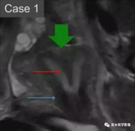 子宫发育异常，应想到的6大类常见畸形