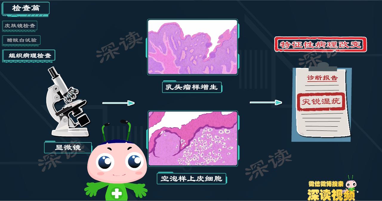 液氮冷冻治疗尖锐湿疣,冷冻和激光治疗尖锐湿疣的效果