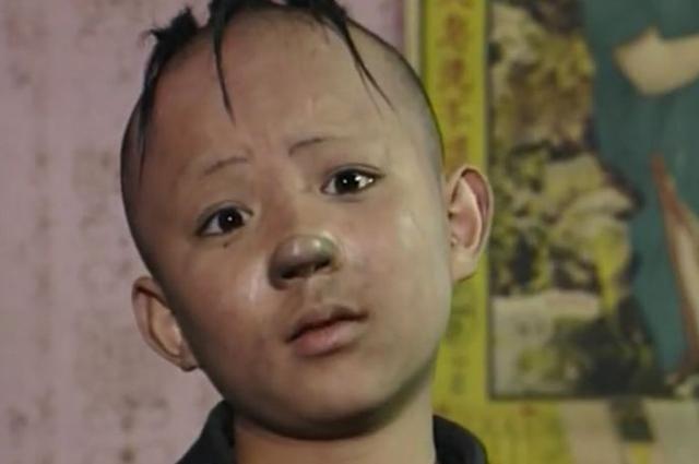 “三毛”34岁了！8岁爆火，14岁谢顶，植发挨300多针，如今变帅哥