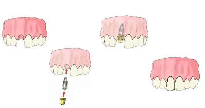 烤瓷牙桥适用于什么,烤瓷桥好处