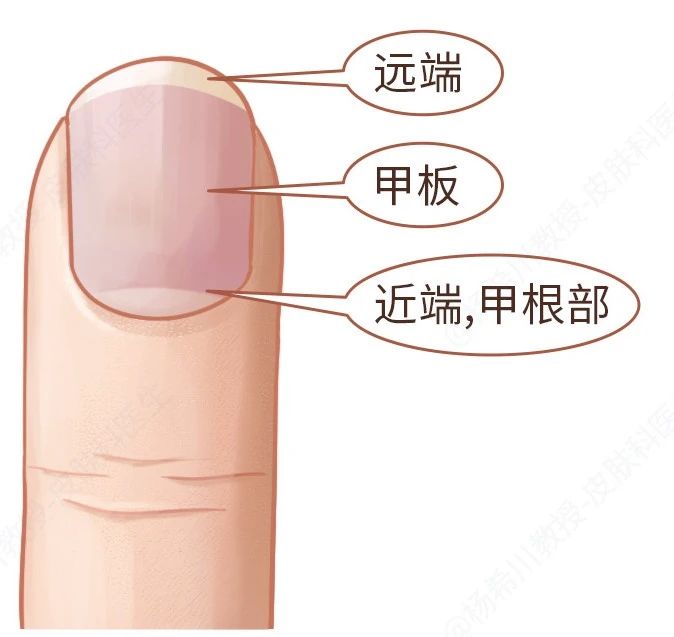 指甲问题对应身体哪里有问题,指甲的各种病变及解决办法