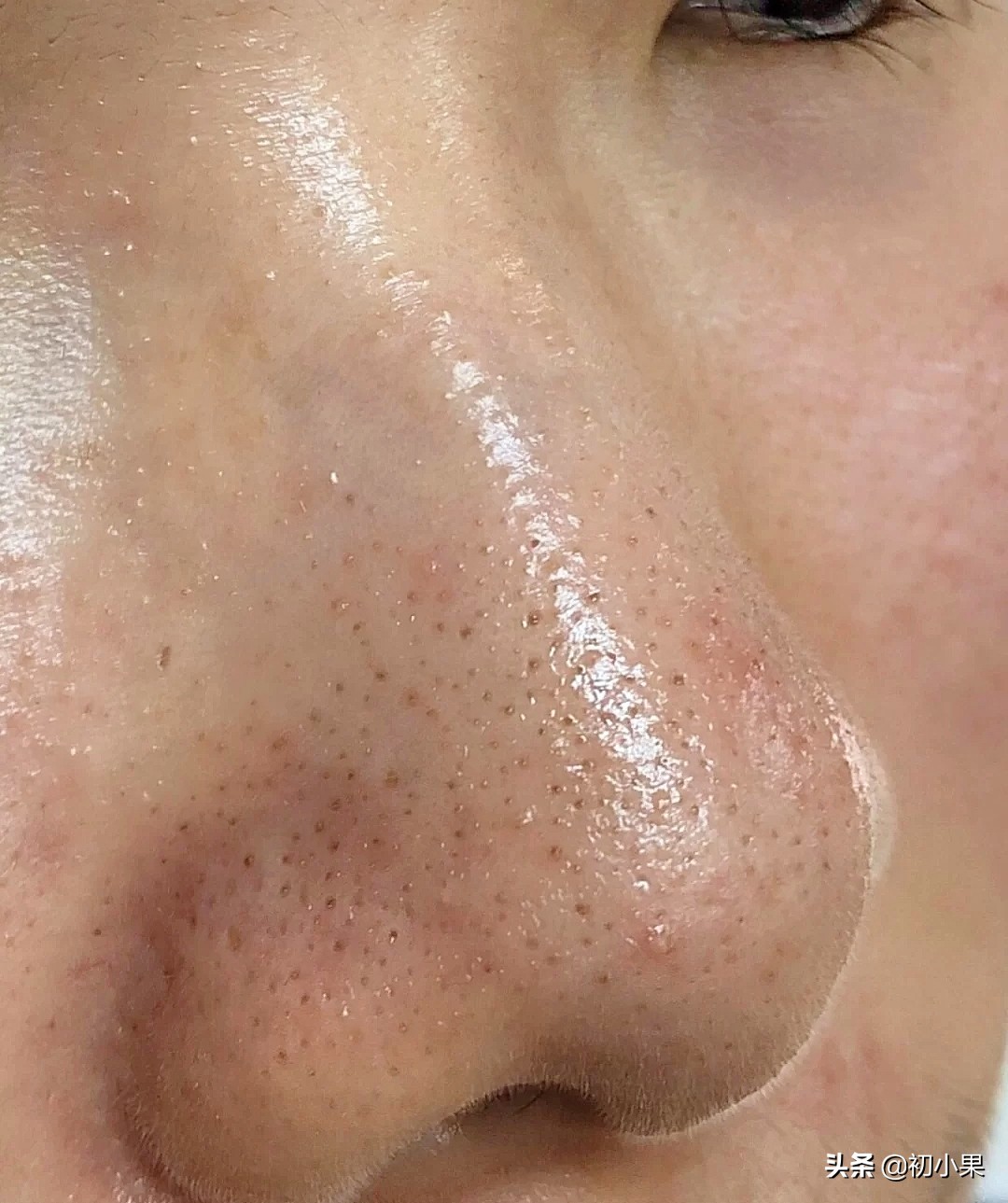 鼻子上的黑头怎么去除,鼻子上的黑头怎么去除小孩