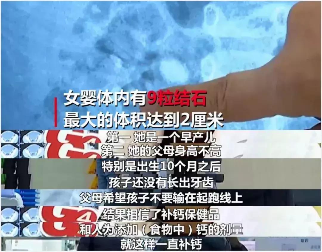 1岁孩子双肾长满结石,五个月婴儿双肾长满结石