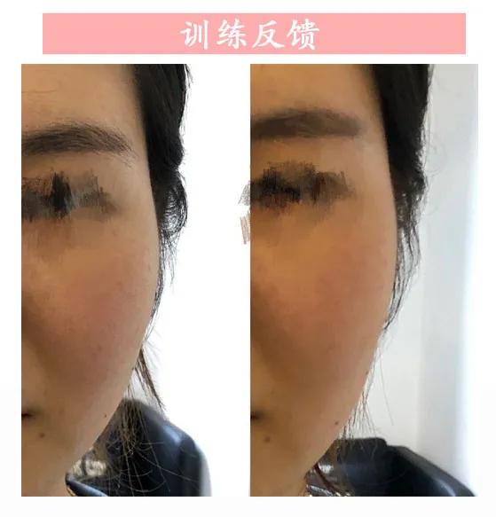 两边颧骨不一样大小如何调整,如何判断颧骨外扩还是颧骨突出