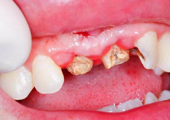 牙齿蛀牙怎么治疗,治疗蛀牙的视频